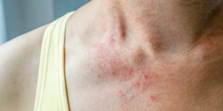 Dust Allergy Troubles? Simple Home Changes That Can Help You Breathe Easy